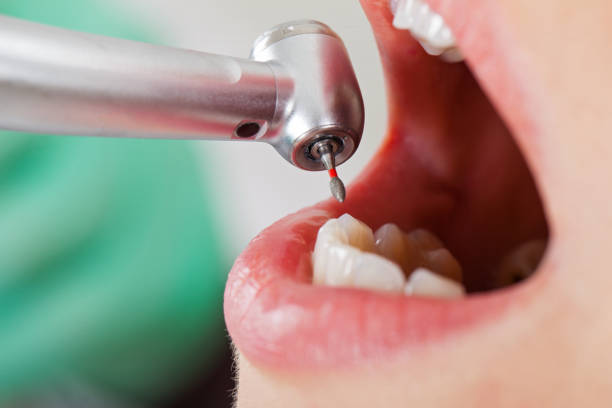 Best Emergency Tooth Extraction in Shadeland, IN